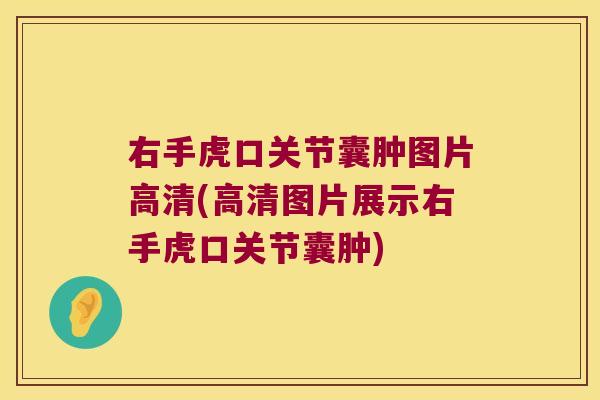 右手虎口关节囊肿图片高清(高清图片展示右手虎口关节囊肿) 右手虎口关节囊肿图片高清(高清图片展示右手虎口关节囊肿)