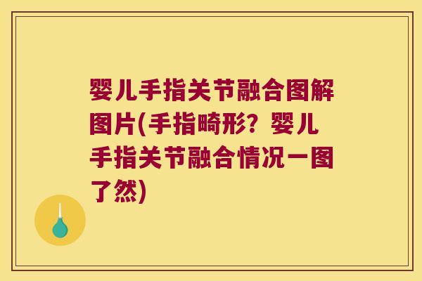 婴儿手指关节融合图解图片(手指畸形?婴儿手指关节融合情况一图了然)