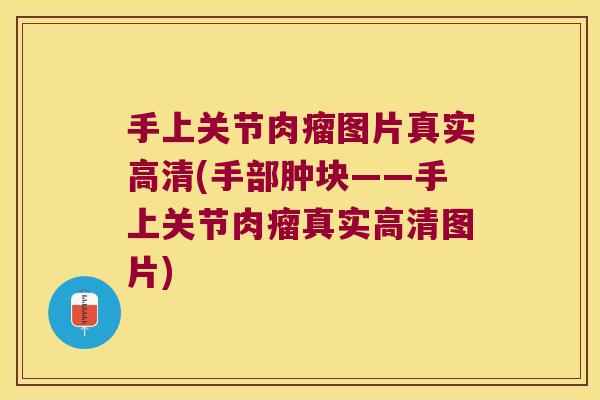 手上关节肉瘤图片真实高清(手部肿块——手上关节肉瘤真实高清图片)